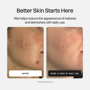 Before and after comparison of skin with redness and blemishes, showing a cleaner appearance after 14 days of daily use.